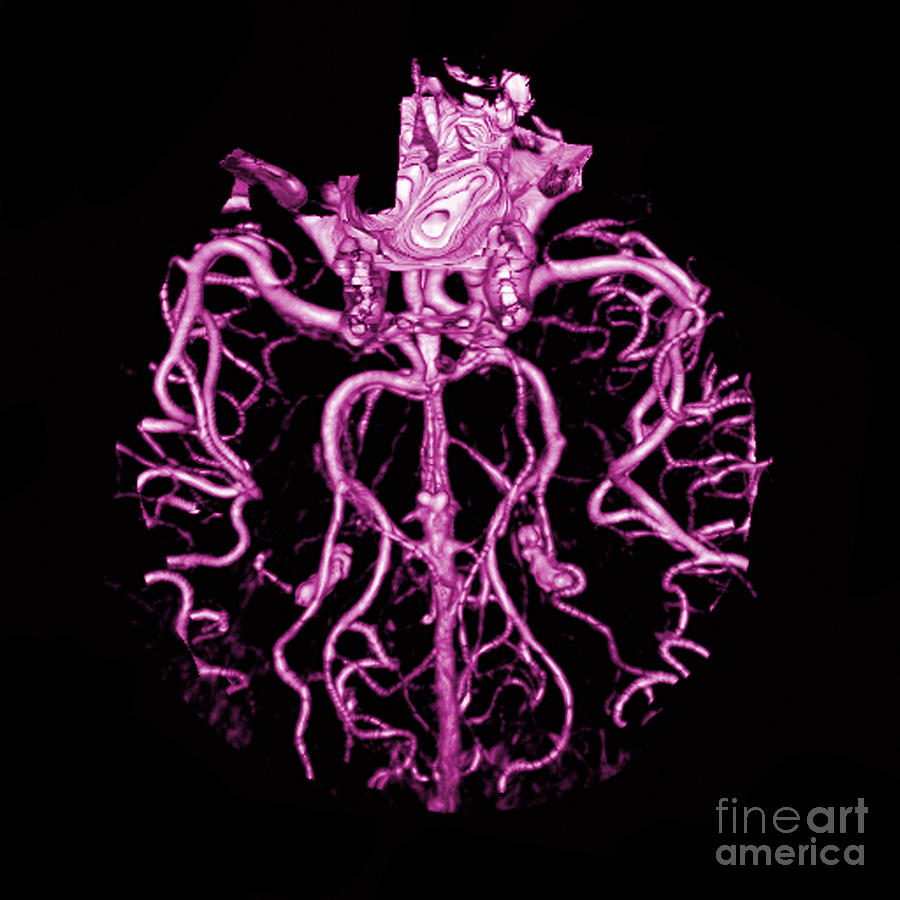 Intracranial Ct Angiogram #2 Photograph by Medical Body Scans