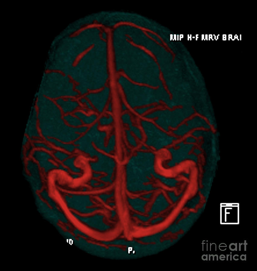 Intracranial Magnetic Resonance Venogram #2 Photograph by Medical Body Scans