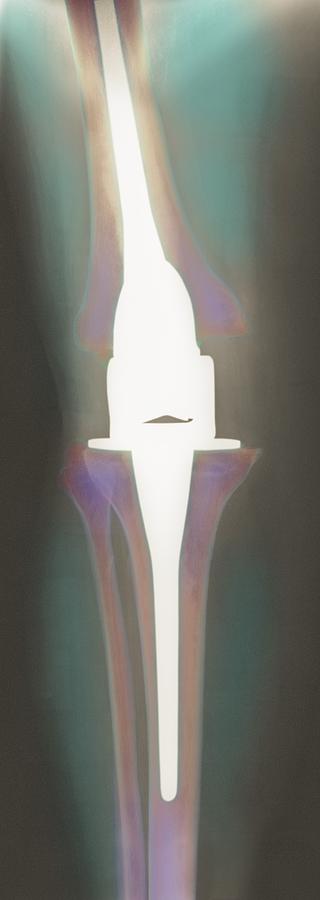 Knee Photograph - Knee Replacement, X-ray #2 by 