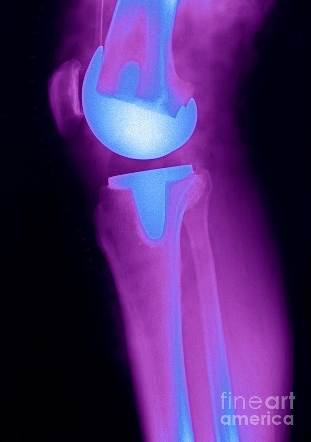 Knee Replacement X-ray #2 Photograph by Ted Kinsman