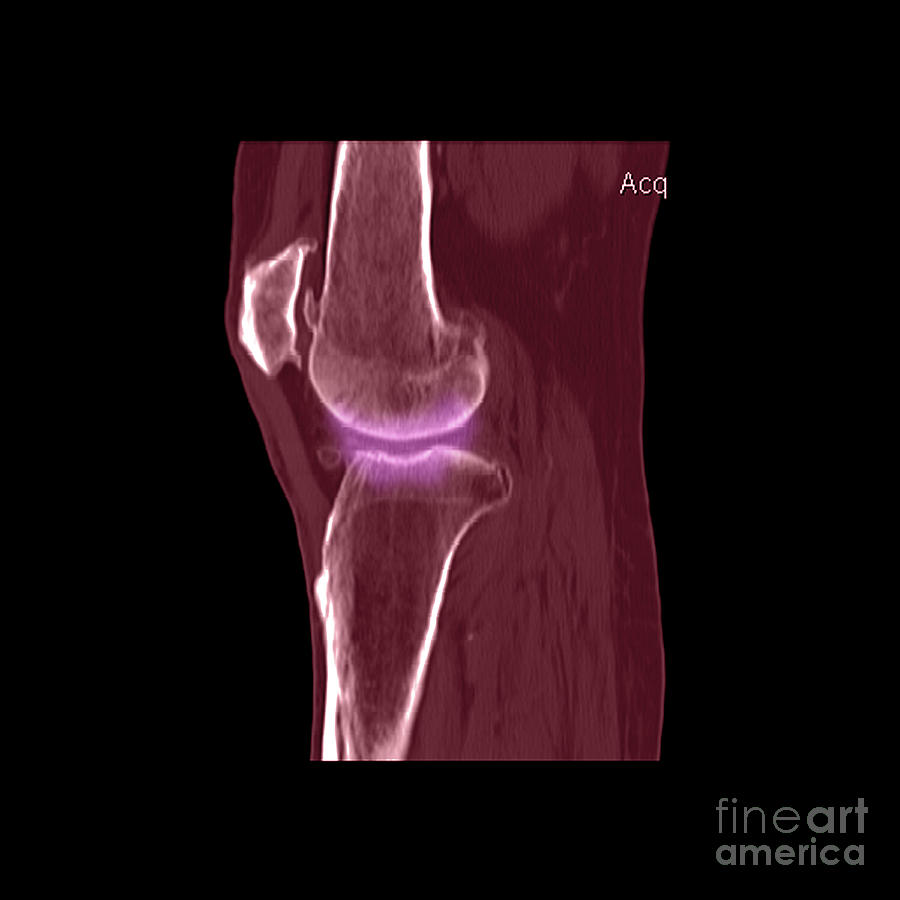 Knee Showing Osteoporosis #2 Photograph by Medical Body Scans