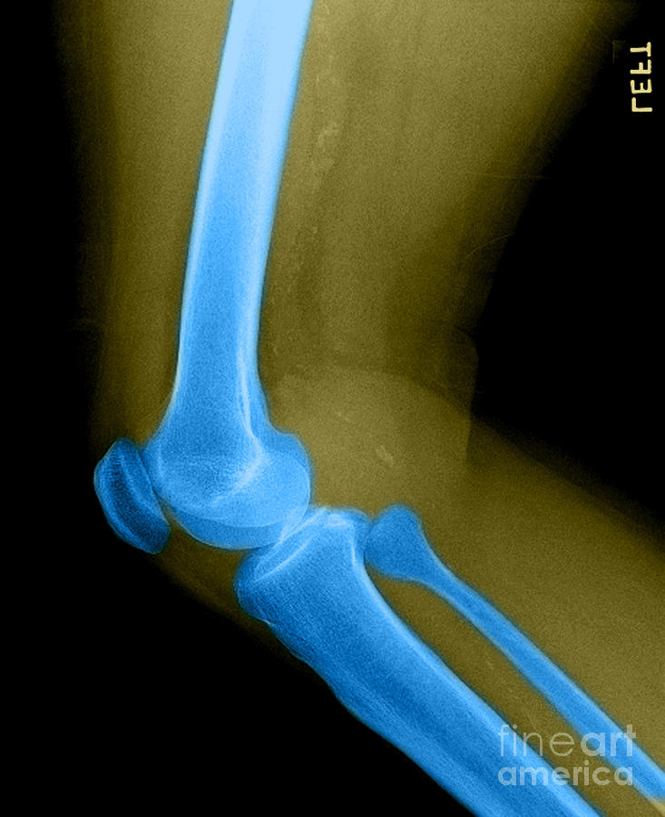 Bone Photograph - Lateral X-ray Of The Knee #2 by Medical Body Scans