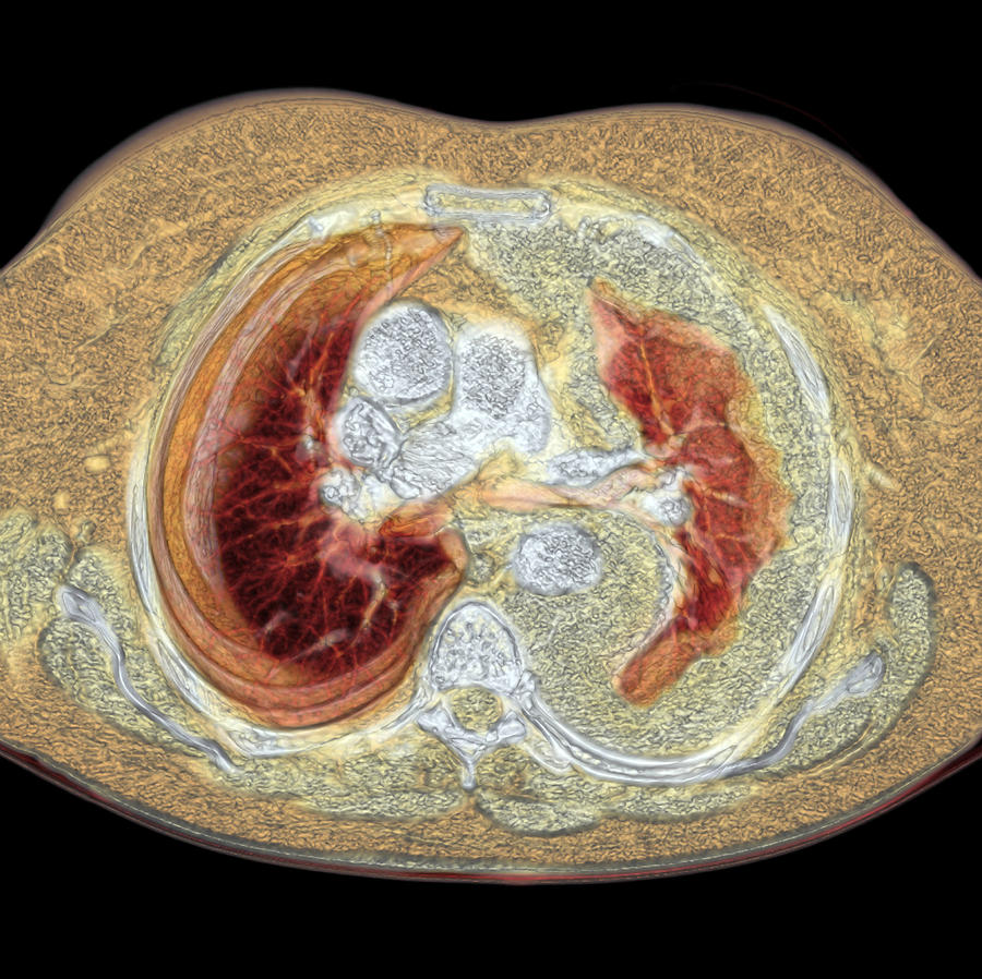 lung-cancer-ct-scan-photograph-by-du-cane-medical-imaging-ltd