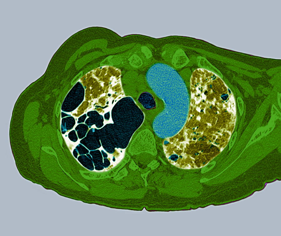 Lung Fibrosis, Ct Scan #2 by Du Cane Medical Imaging Ltd