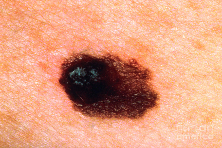 Melanoma #2 Photograph by Science Source