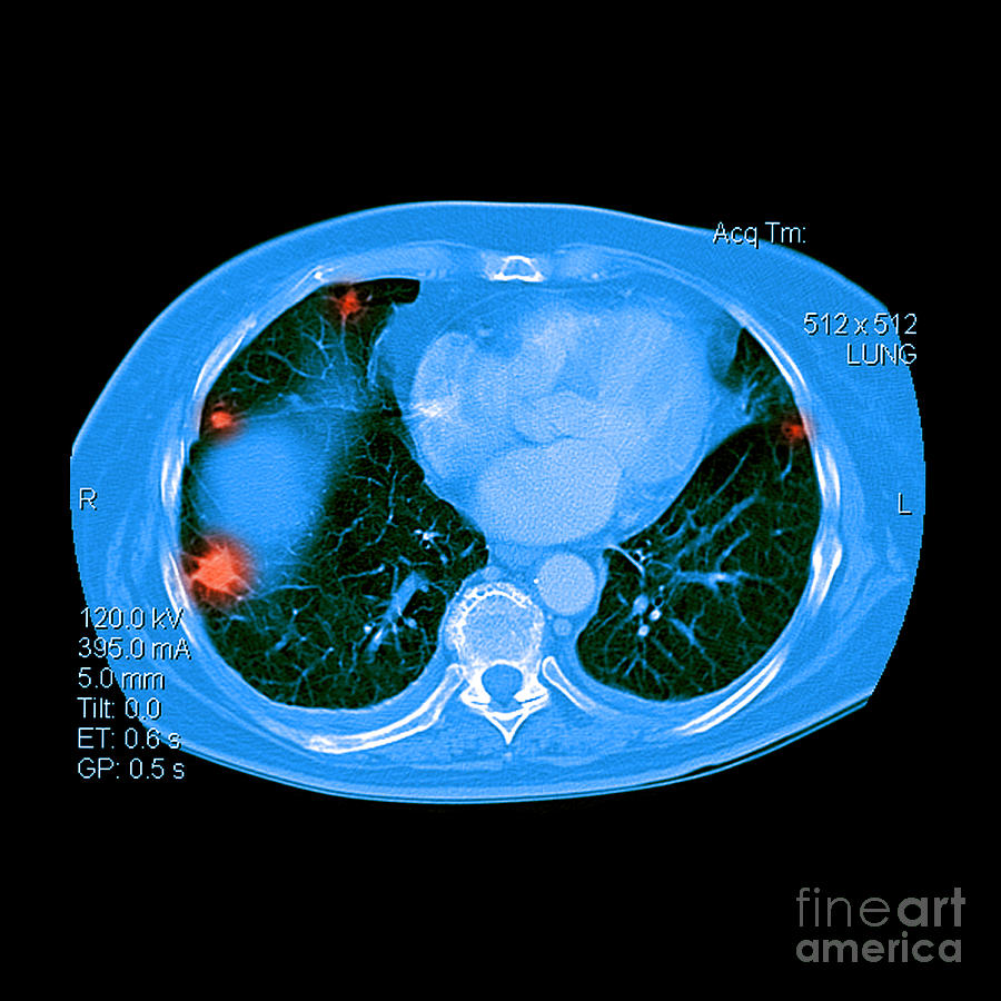 Cancer Photograph - Metastatic Cancer Of The Lungs #2 by Medical Body Scans