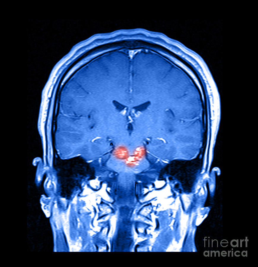 Mri Brainstem Cavernous Malformations #2 Photograph by Medical Body Scans