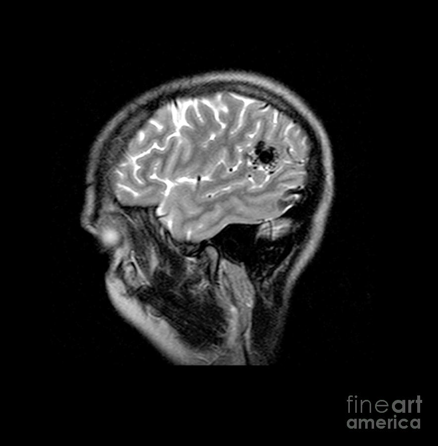 Mri Of Brain Avm #2 Photograph by Medical Body Scans