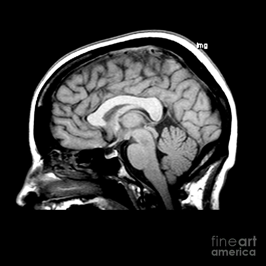 Mri Of Brain #2 Photograph by Medical Body Scans