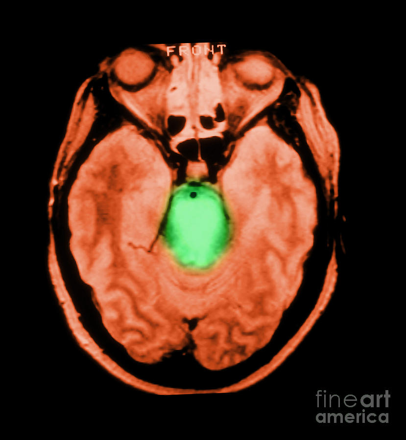 Mri Of Brainstem Glioma #2 Photograph by Medical Body Scans