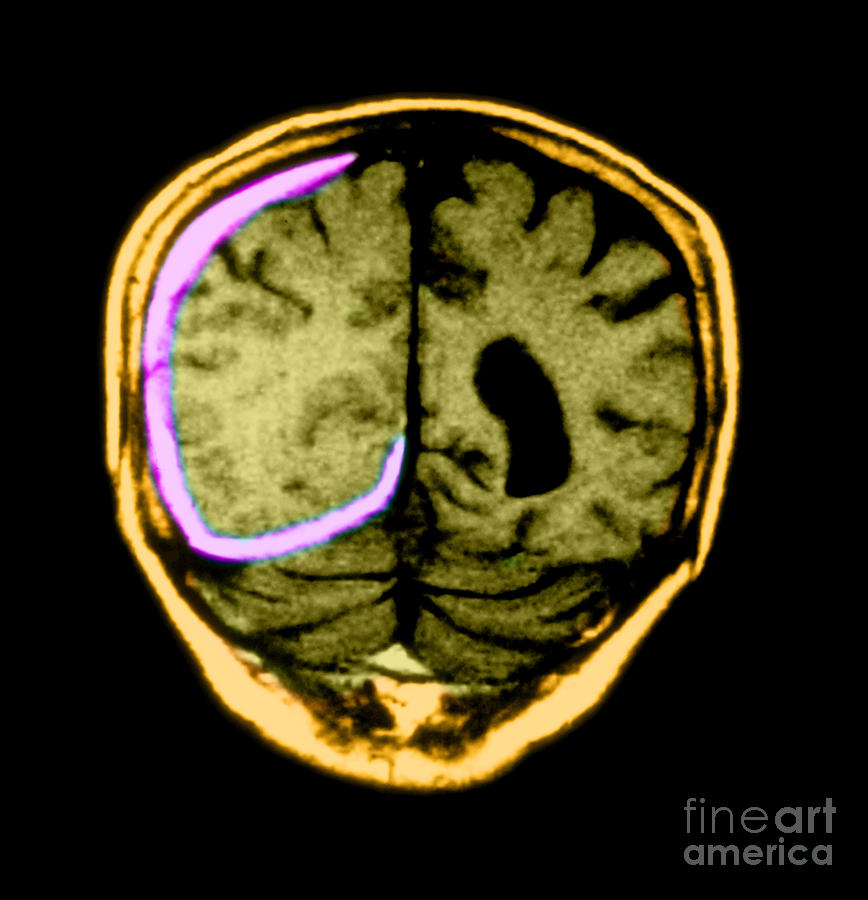 Mri Of Head Trauma #2 Photograph by Medical Body Scans