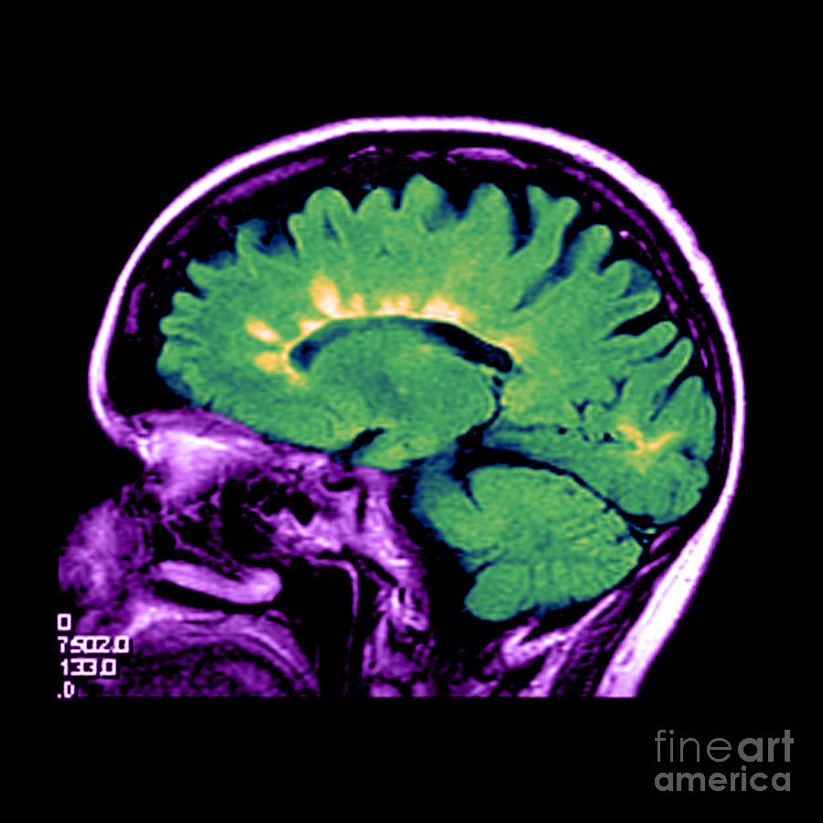 Mri Of Multiple Sclerosis Photograph By Medical Body Scans Fine Art