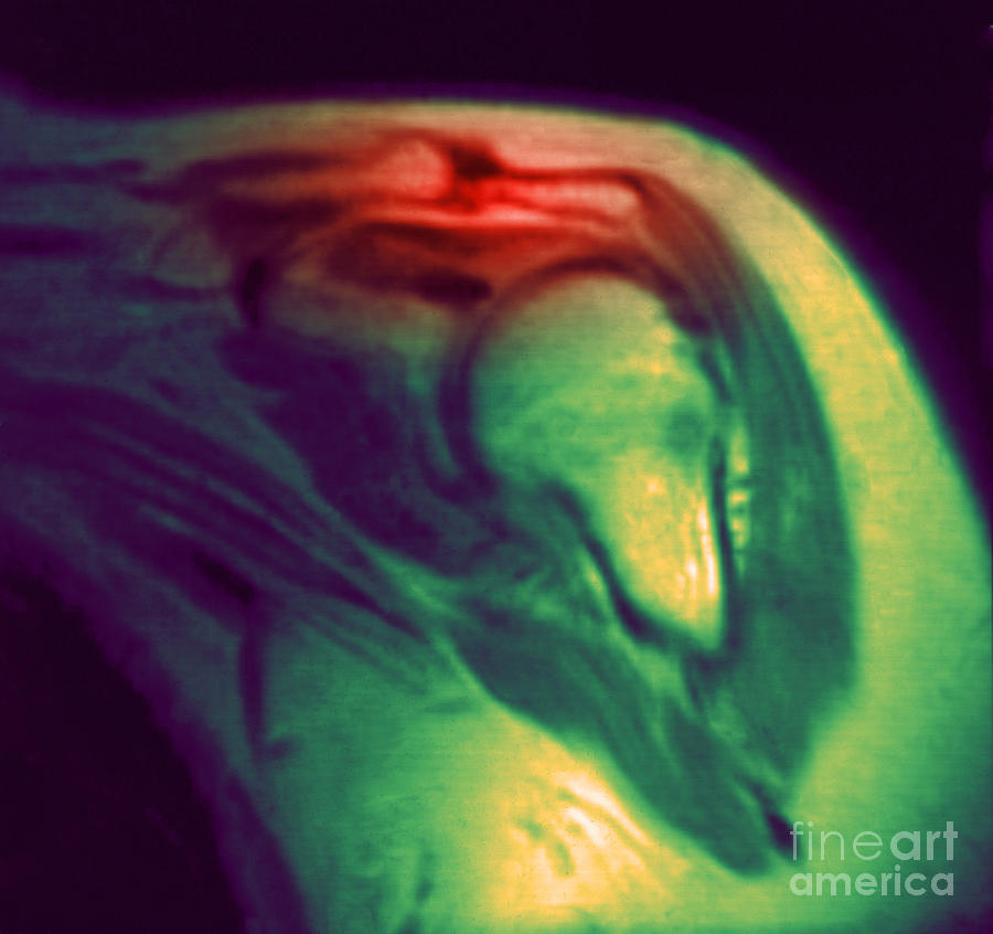 Mri Of Shoulder With Impingement #2 Photograph by Science Source
