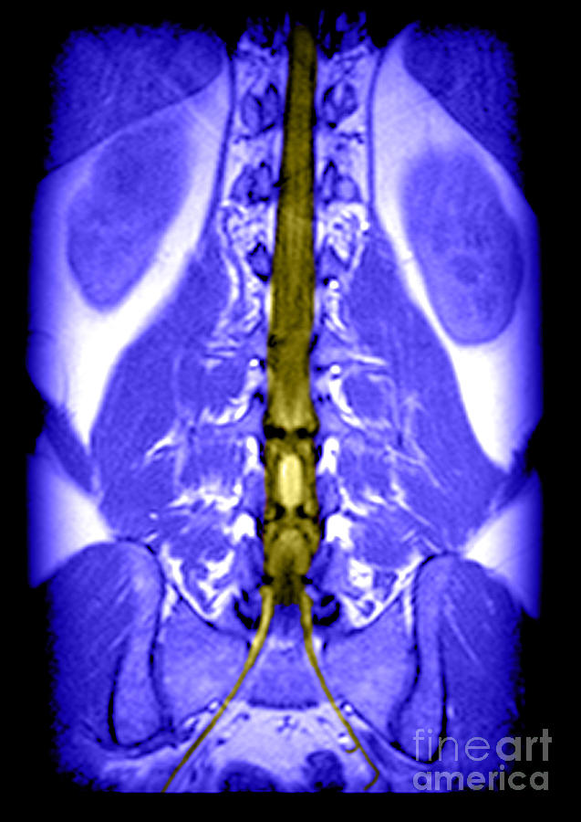 Mri Of Spinal Cord And Nerve Roots #2 Photograph by Medical Body Scans