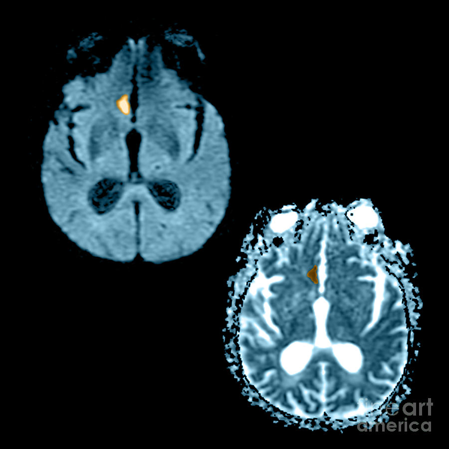 Mri Of Stroke #2 Photograph by Medical Body Scans