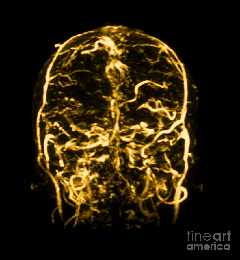 Abnormal Mri Brain Photograph - Mri Of Venogram Of Dural Sinus #2 by Medical Body Scans