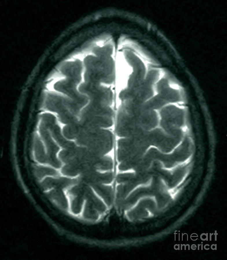 Mri Showing Arachnoid Cyst #2 Photograph by Science Source