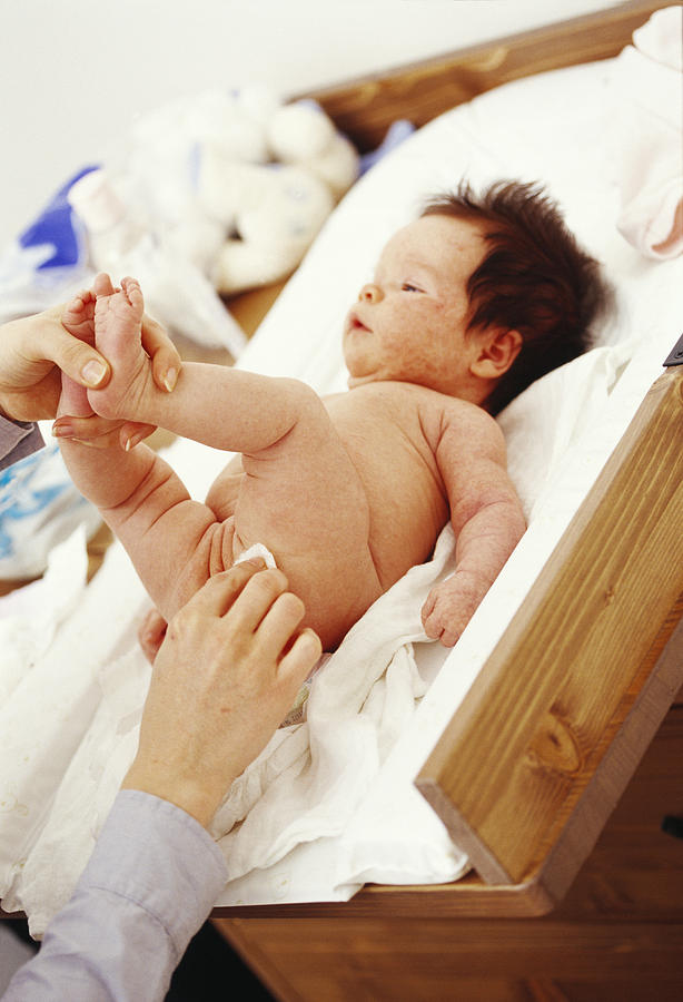 Cream On Baby Girl S Buttocks During Nappy Change Acrylic Print