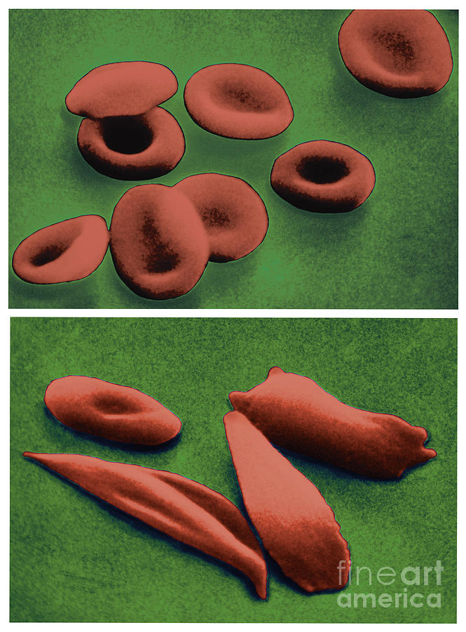 Normal And Sickle Red Blood Cells #2 Photograph by Omikron