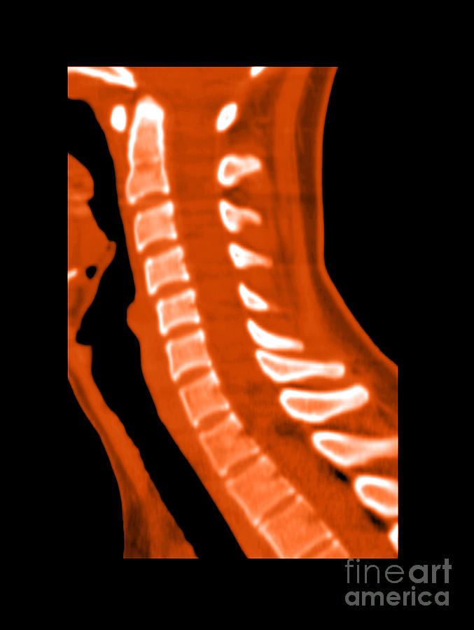 Skeleton Photograph - Normal Cervical Spine #2 by Medical Body Scans