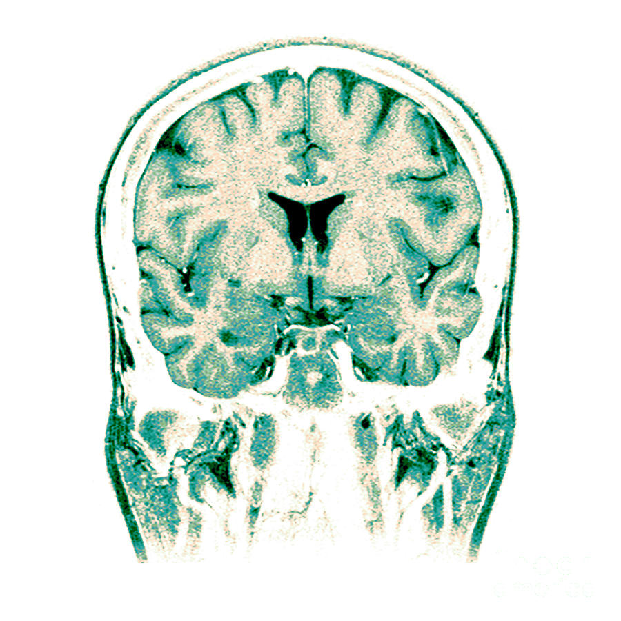 Normal Coronal Mri Of The Brain #2 Photograph by Medical Body Scans