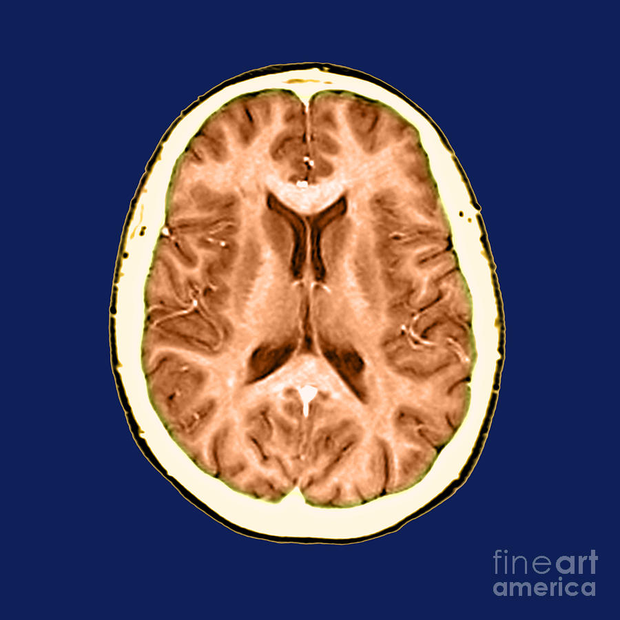 Normal Cross Sectional Mri Of The Brain #2 Photograph by Medical Body Scans