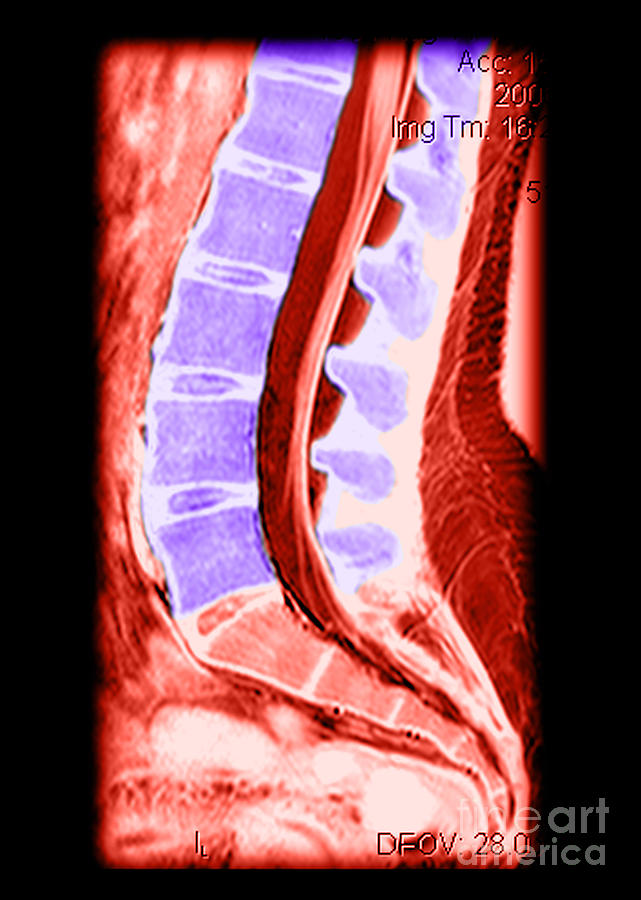 Normal Lumbar Spine #2 Photograph by Medical Body Scans