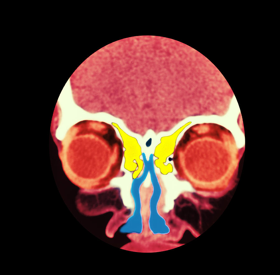 Nose And Sinuses, Ct Scan Photograph by Pixels