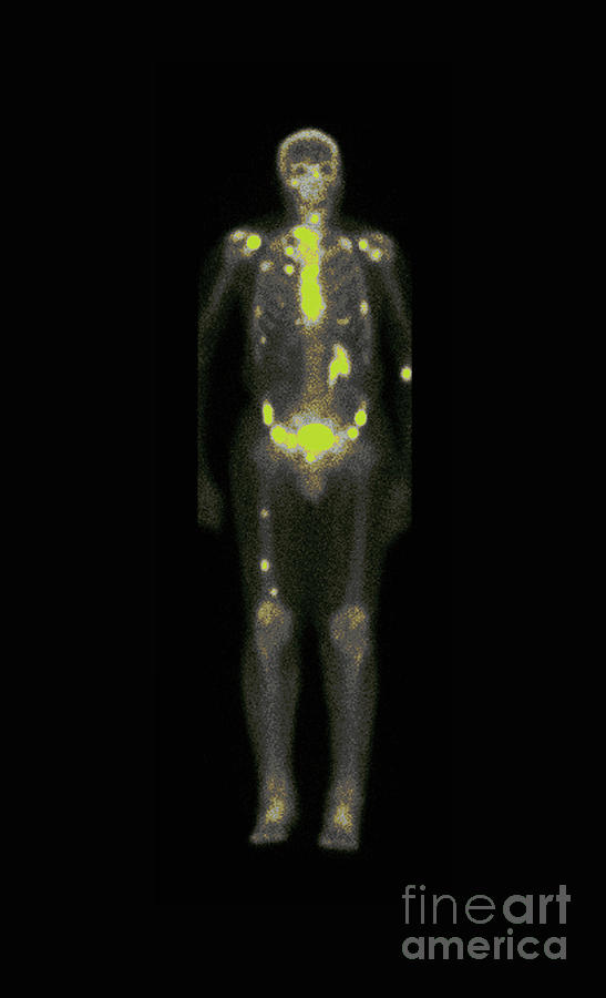 Nuclear Medicine Bone Scan #2 Photograph by Medical Body Scans