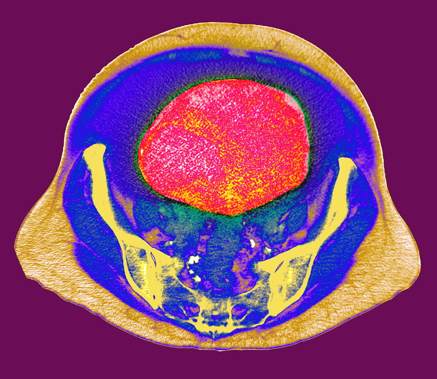 Ovarian Cancer, Ct Scan Photograph by Du Cane Medical Imaging Ltd ...