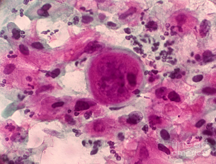Medical Photograph - Pap Smear, Cancer #2 by Science Source