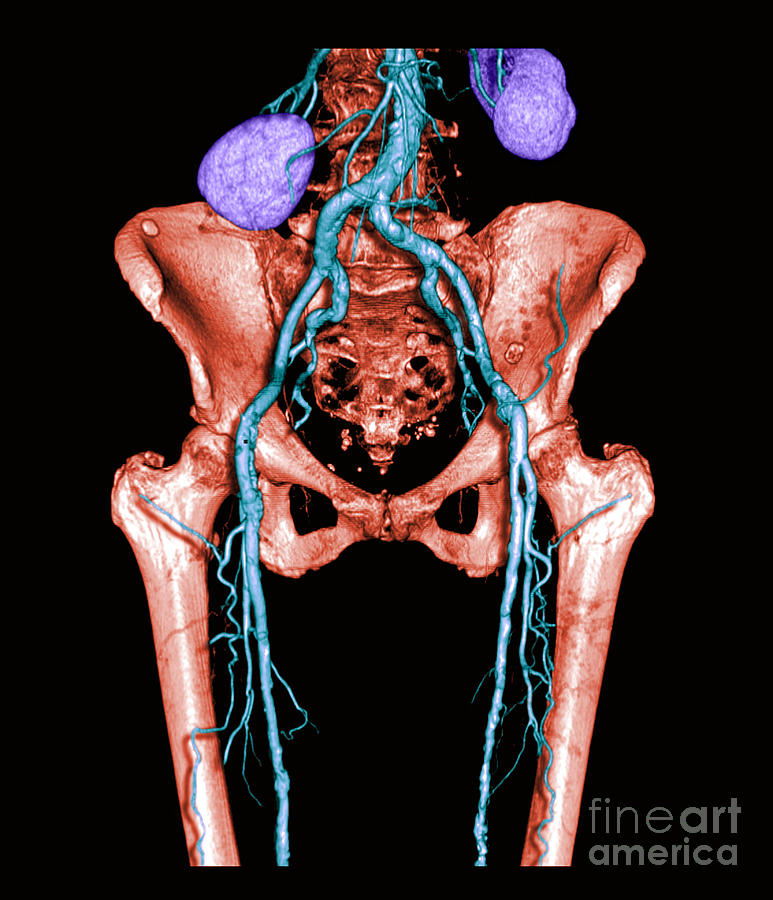 Pelvis And Upper Legs #2 Photograph by Medical Body Scans