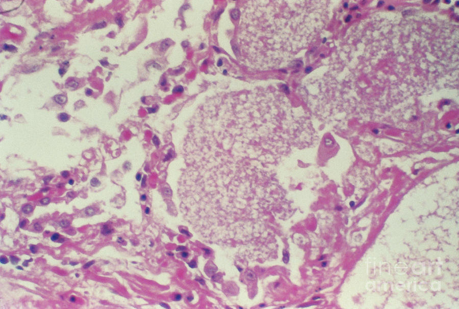 Pneumocystis Jirovecii In Lung Lm Photograph by Science Source