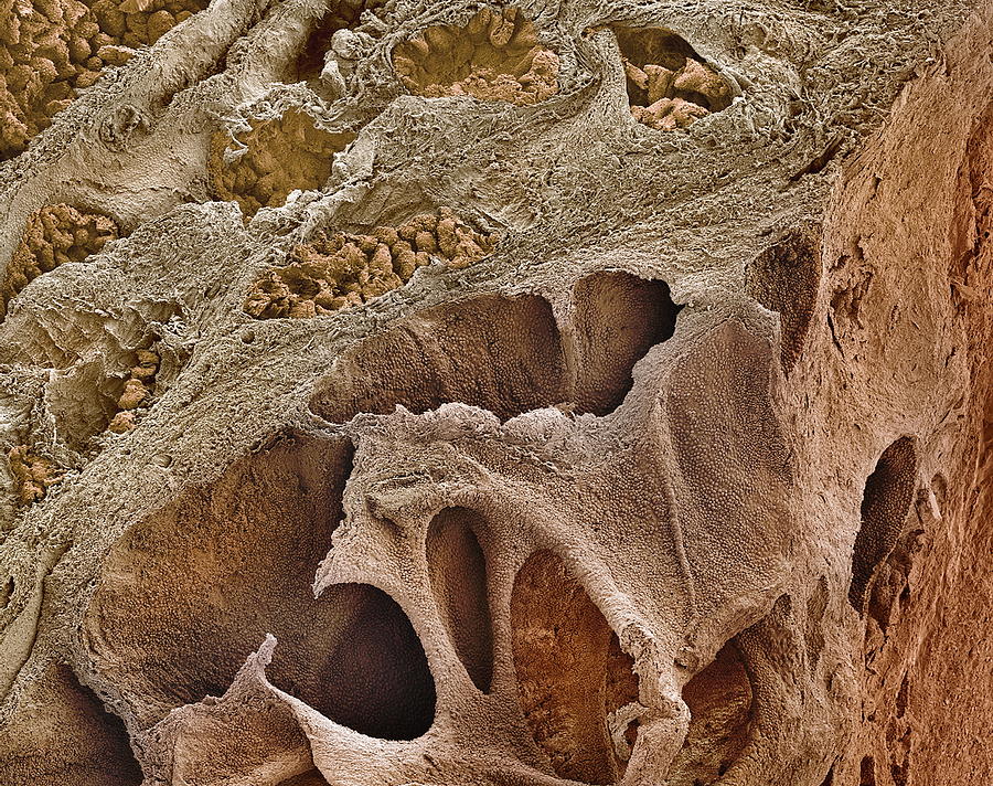 Prostate Cancer Sem Photograph By Steve Gschmeissner Fine Art America 8693