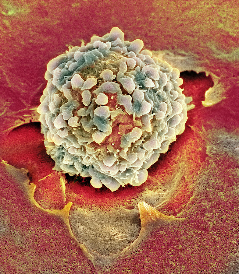 Rectal Cancer Cell Sem Photograph By Steve Gschmeissner Fine Art America