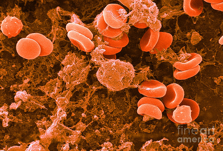 Red Blood Cells, Rouleaux Formation, Sem #2 Photograph by Science Source