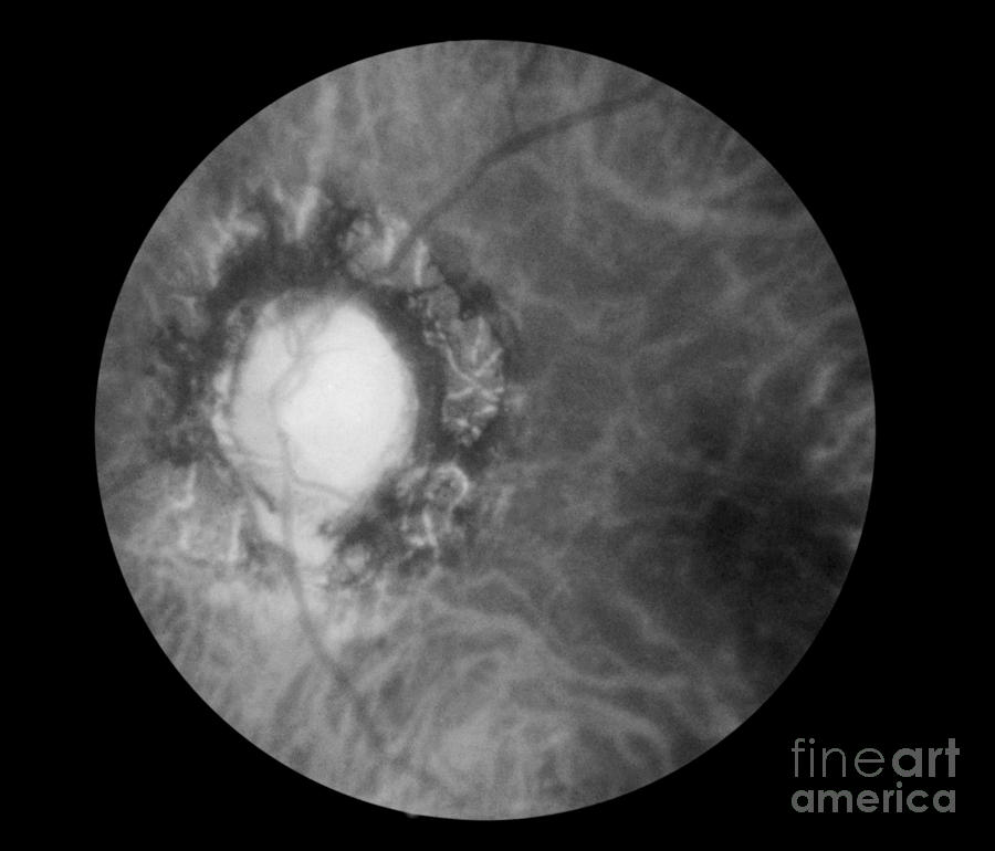 Retina Infected By Syphilis #2 Photograph by Science Source