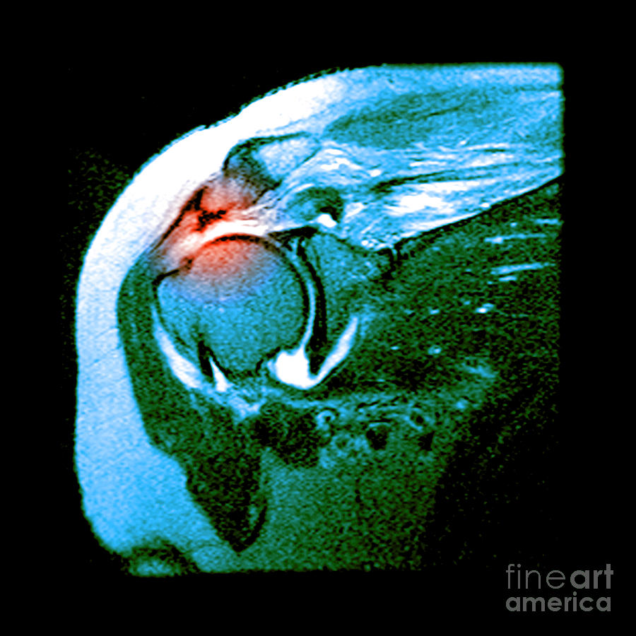 Rotator Cuff Tear Photograph by Medical Body Scans