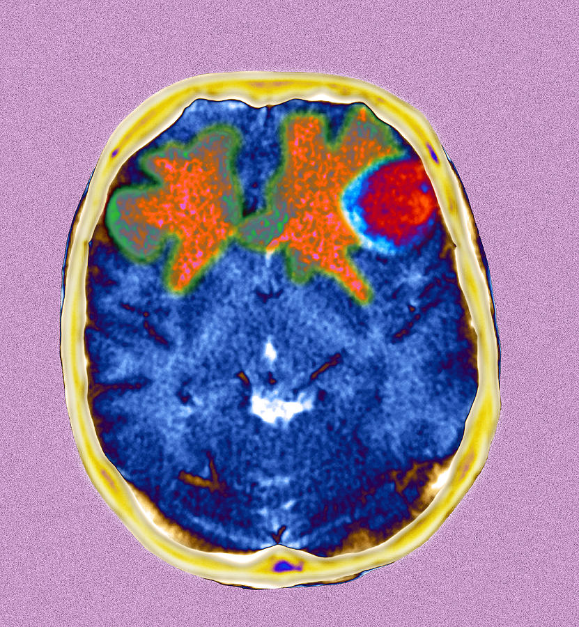 Secondary Brain Cancers Ct Scan Photograph By Du Cane Medical Imaging