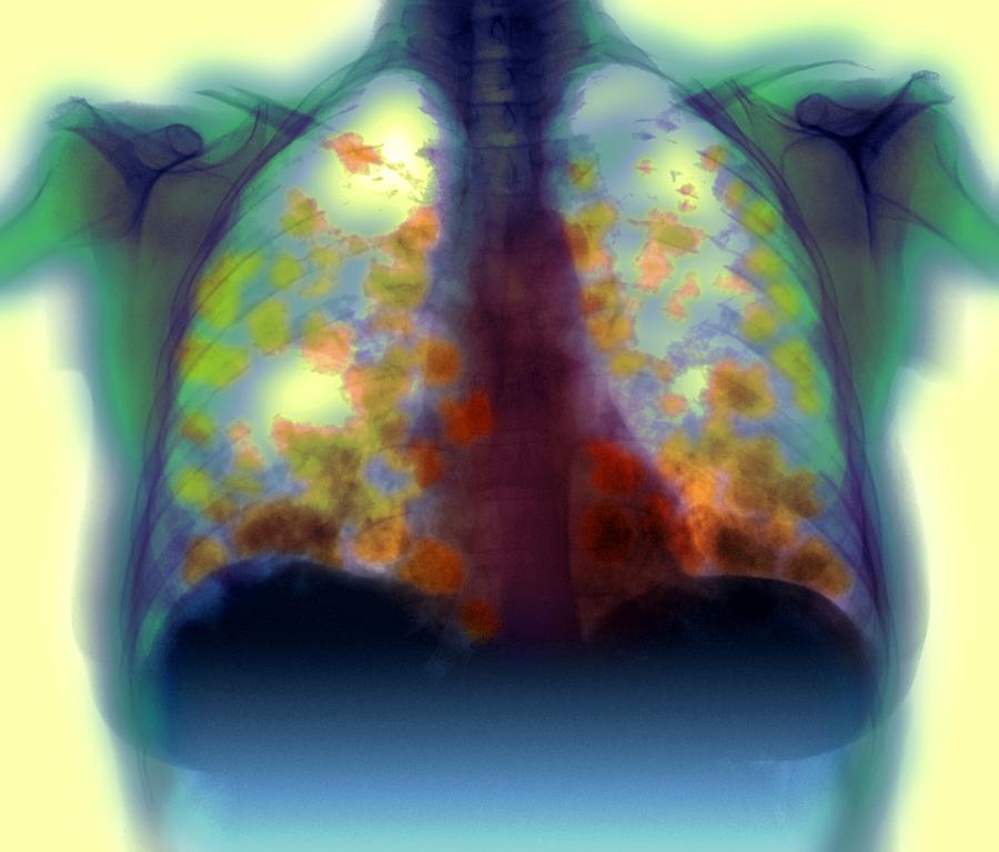 Medicine Photograph - Secondary Lung Cancers, X-ray #2 by Du Cane Medical Imaging Ltd
