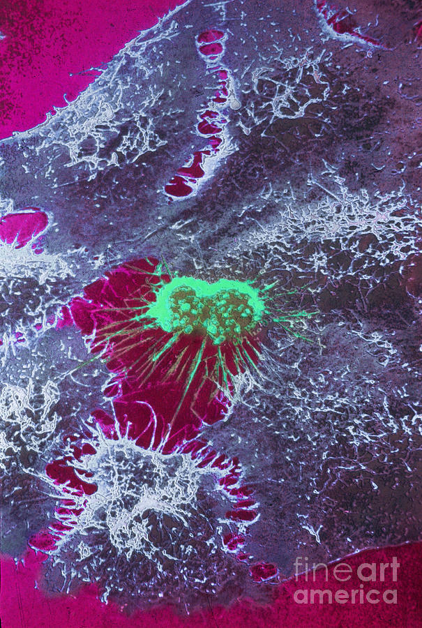 Sem, Hela Cells With Adenovirus #2 Photograph by Science Source