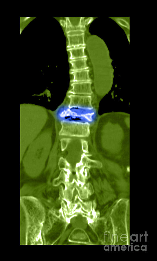 Severe Osteoporosis #2 Photograph by Medical Body Scans