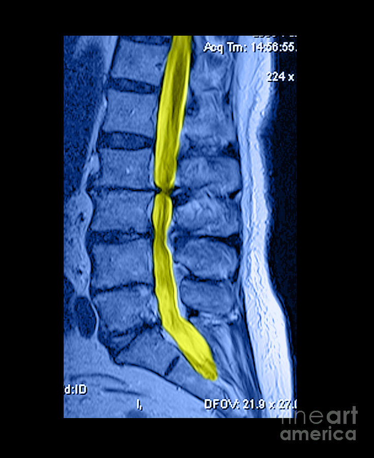Severe Spinal Stenosis #2 Photograph by Medical Body Scans