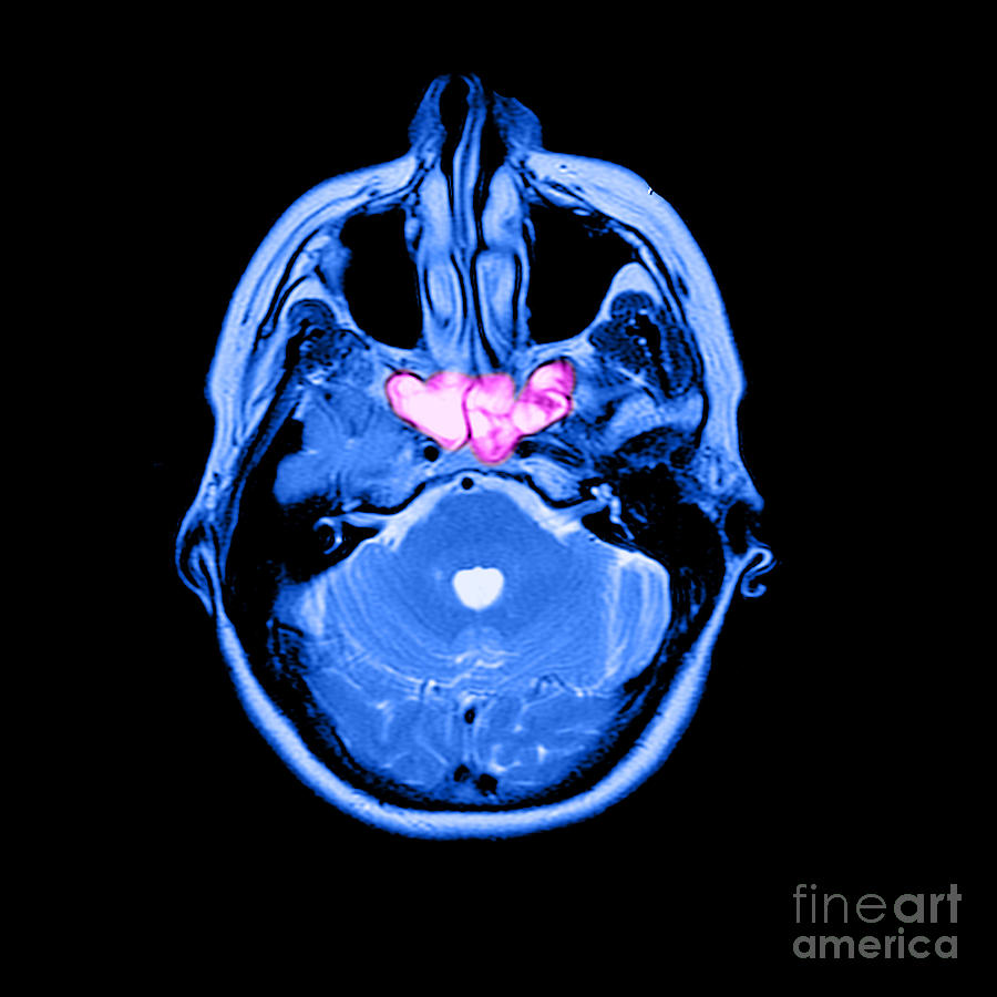 Sinusitis #2 Photograph by Medical Body Scans