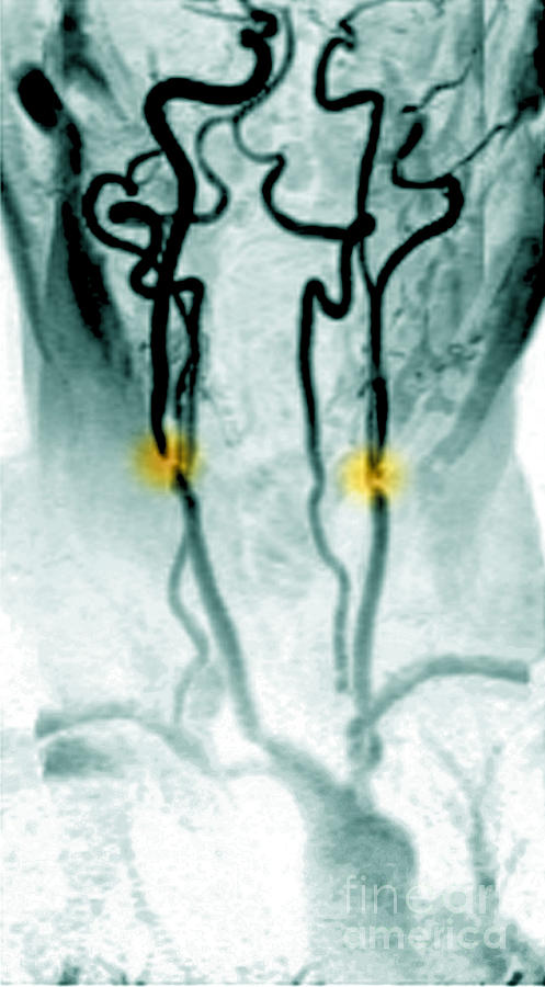 Stenosis Of The Internal Carotid #2 Photograph by Medical Body Scans