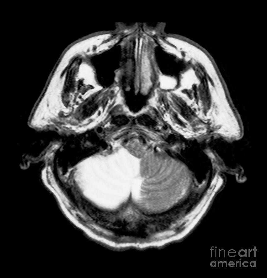 Stroke #2 Photograph by Medical Body Scans