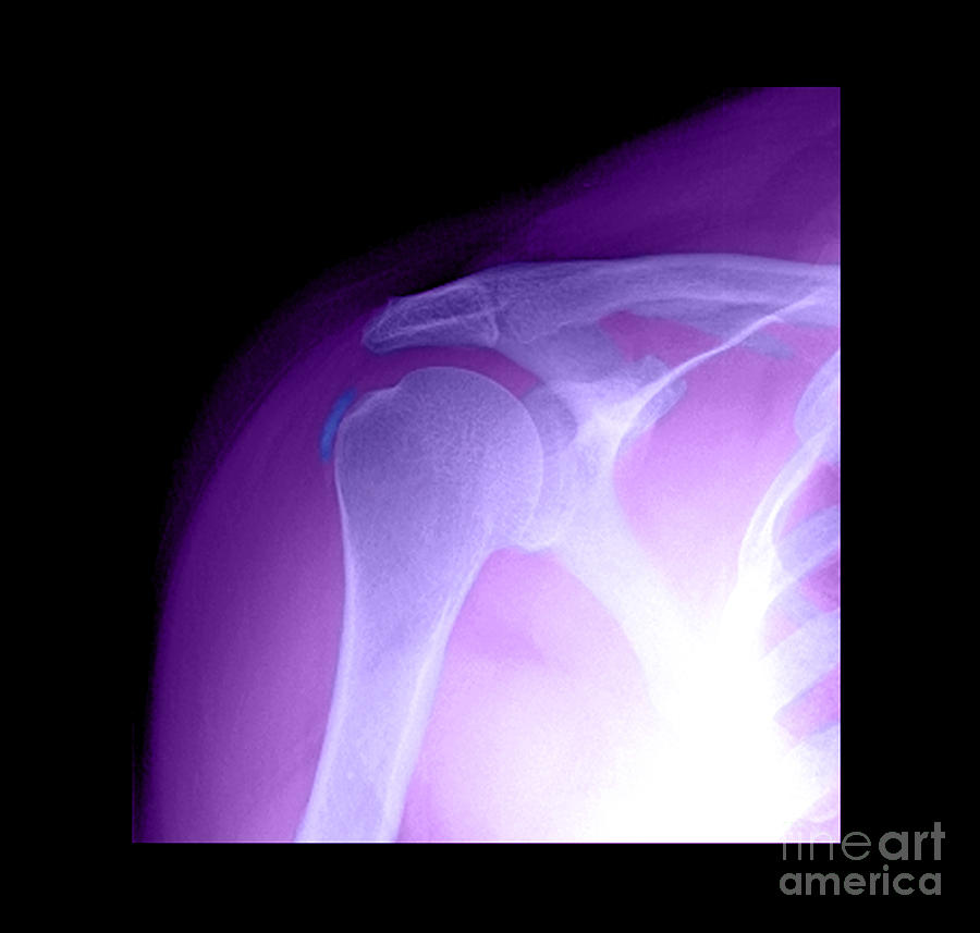 Tendinitis #2 Photograph by Medical Body Scans