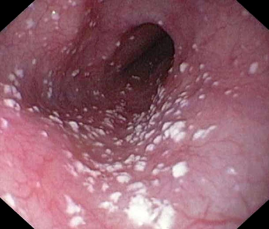 Endoscopy Photograph - Thrush In The Oesophagus #2 by Gastrolab