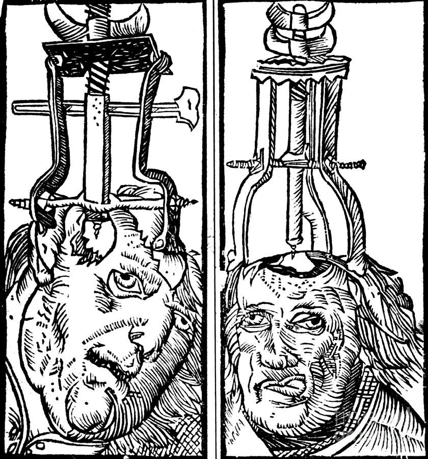 Trepanning 1525 #3 Photograph by Science Source