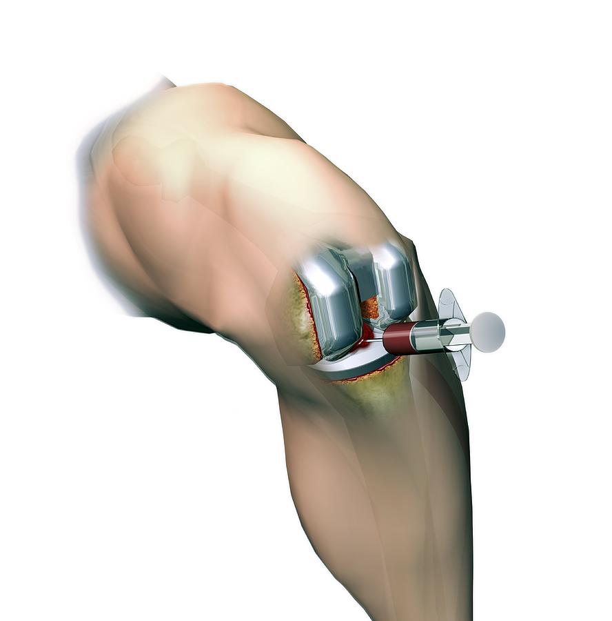 Total Knee Replacement Photograph - Woundcare Gel Therapy, Artwork #2 by D & L Graphics